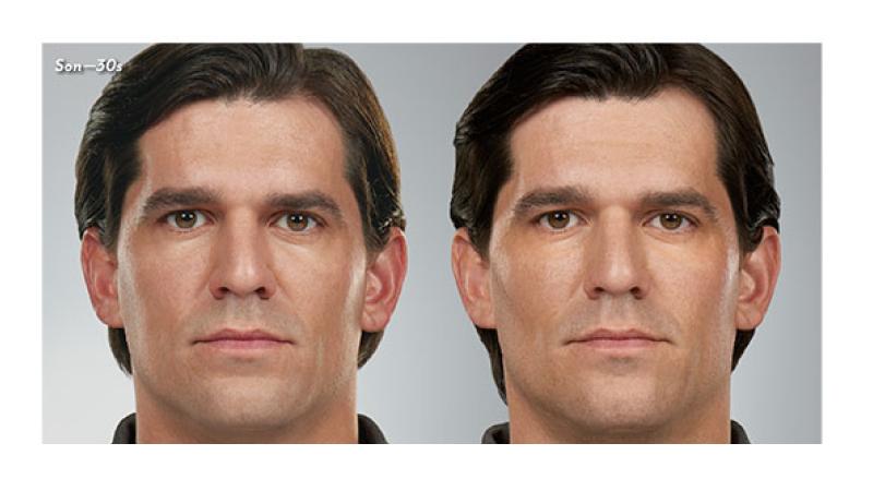 Juvederm Collection Of Fillers St Peter s Health